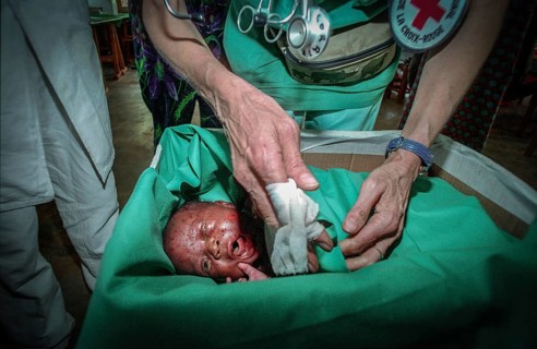 RWA Rwanda Kigali An injured Tutsi refugee child is receiving medical care in a makeshift hospital