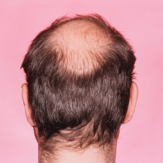 Close-up of the back of a man's head with a distinct bald head or hair loss