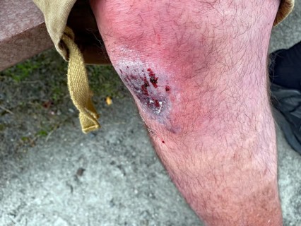 Close-up of injured knee with skin abrasion and wound, fall, bike travel, Scotland, United Kingdom