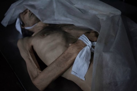 Body of a man who died of tuberculosis, morgue of the State Hospital, Chisinau, Moldova