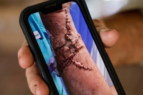 Close-up of a healed scar from a crocodile attack on a smartphone, Adelaide River, Northern