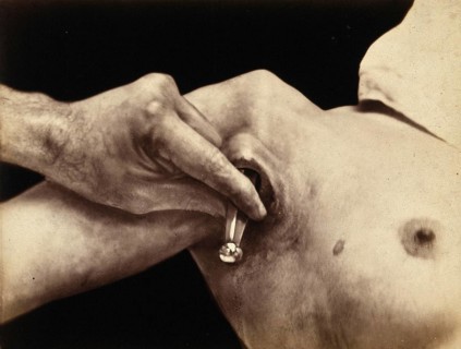 Patient, operation, a surgical instrument made of metal is inserted in an incision in the armpit,