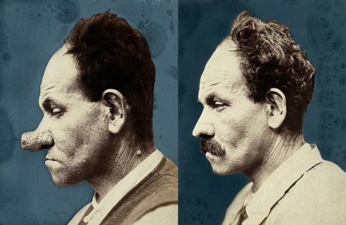 Cosmetic surgery, cosmetic surgery in front of, after. A man with a large, deformed nose who was