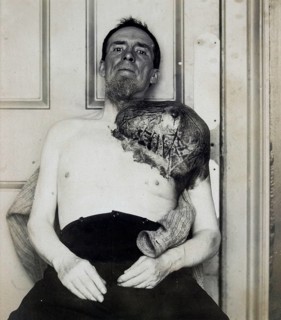 Bone cancer, malignant tumor, sarcoma, man with a large periosteal sarcoma, that from his shoulder.