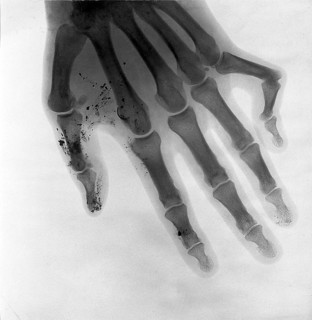 Bone of a hand, deformed little finger, fracture of the joint, X-ray, X-ray, around 1900 medicine,