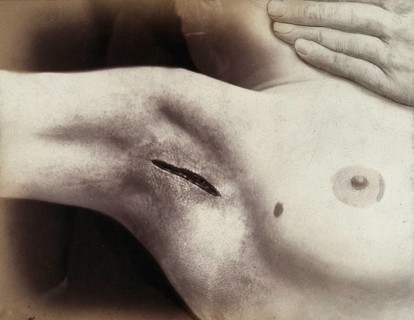 Patient, operation, an cut in the armpit to operation silverware, medicine, history of medicine,