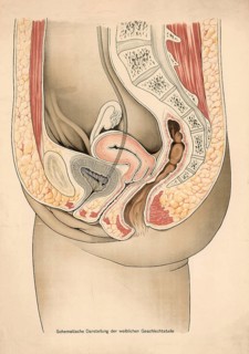 Medical illustration, clinical picture, venereal disease, schematic representation of female