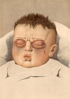 Medical illustration, clinical picture, venereal disease, tripper eye, symptoms of gonorrhea in the
