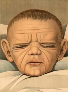 Medical illustration, clinical picture, venereal disease, syphilis, hereditary syphilis, child with