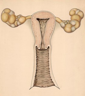 Medical illustration, clinical picture, venereal disease, gonorrhea, female reproductive organs