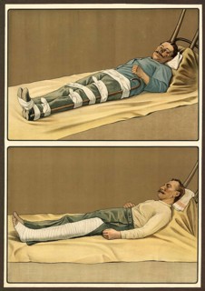 First aid, emergency treatment for broken bones, school picture, authentic reproduction of a school