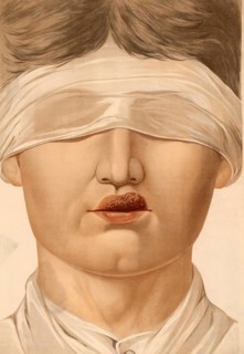 Medical illustration, clinical picture, venereal disease, primary affect of syphilis on the upper
