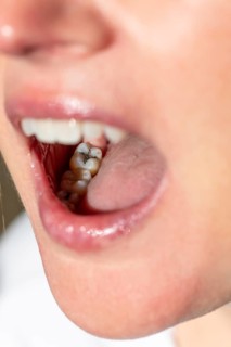 Woman with her mouth open shows a visible amalgam filling on her molar during a dental examination