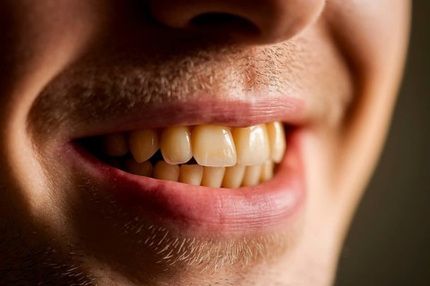Close-up of stained male teeth revealing nicotine discoloration and enamel texture. Generative ai,