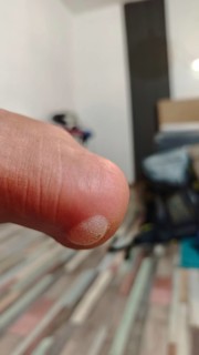 Close-up of a heel with a huge bladder from hiking with a backpack in the background, consequences