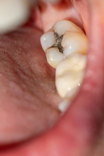 Woman with her mouth open shows a visible amalgam filling on her molar during a dental examination