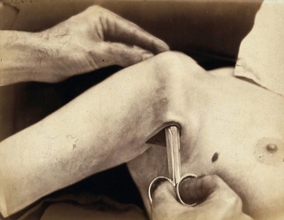 Patient, operation, a surgical instrument made of metal is inserted in an incision in the armpit,