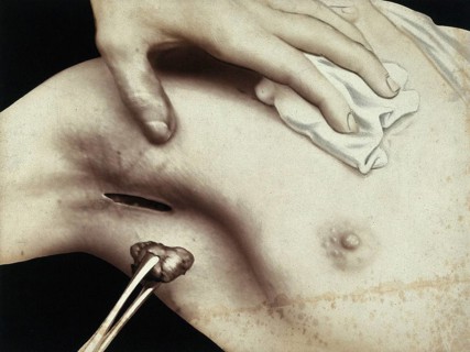 Patient, surgery, breast surgery, lump removal, tumor, metal surgical instrument inserted through
