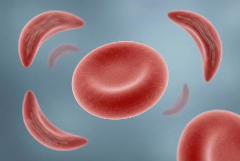 Visualization of CRISPR gene therapy for sickle cell anemia: An altered red blood cell that