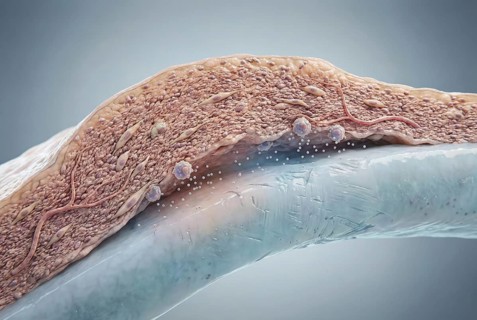 Microscopic 3D illustration of rheumatoid arthritis: An overactive macrophage mistakenly attacks