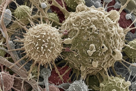 Macro-visualization of a CAR-T immune cell that binds to a tumor cell with cell membranes and tumor