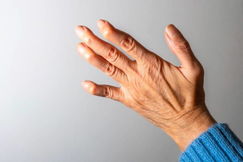 Close up of a senior woman's hand, revealing swollen joints and deformities caused by arthritis