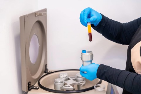 Close-up side view of a technician using blood centrifuge machine for an innovative baldness