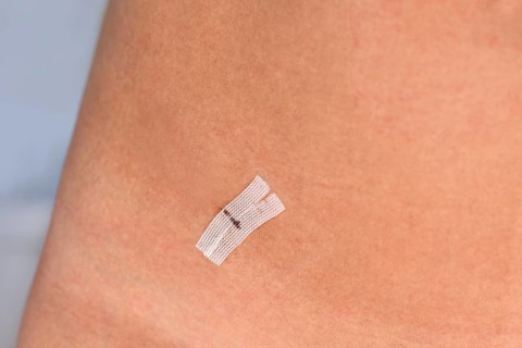 Sterile wound closure strip used on cut after laparoscopy on woman's lower abdomen