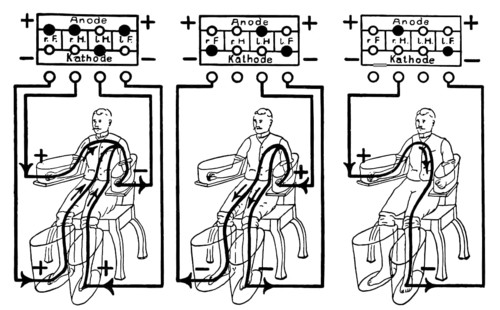 An illustration of a patient being treated with a four cell Schnee Bath, an early electric medical