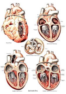 Anatomy, human, various pathological changes of the human heart, fatty heart, heart inner wall