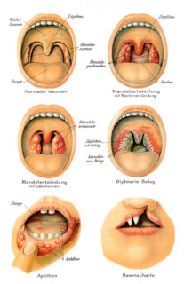 Mouth and throat diseases, health counselor, 19th century, Mund- und Rachenkrankheiten,
