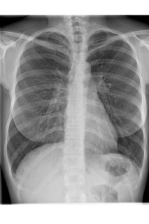X-ray photograph of front view of woman's chest with diagnosis pulmonary emphysema with flattening