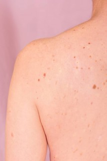 Close-up image of a person's back highlighting moles and pigmentation. Represents the importance of