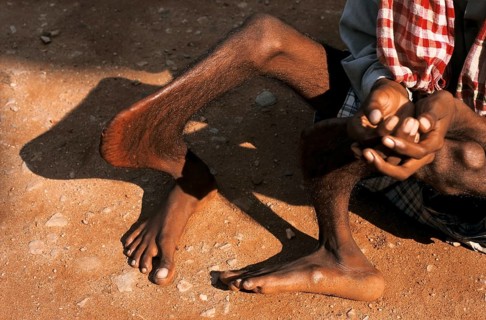 Beggar suffering from legs malformations, Rajasthan, India