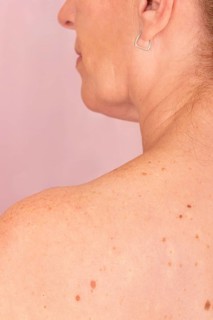 Close-up of a woman's skin with moles, promoting awareness against skin cancer. Highlights health,