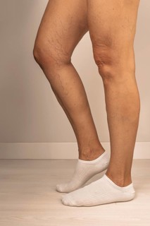 Close-up of a person's legs showing varicose veins and visible capillaries. The individual is