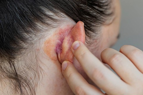 Close-up of skin infection behind the ear showing redness, inflammation, and irritation.