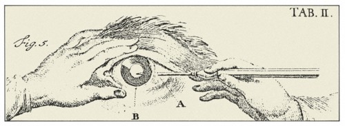 Engraving representing an eye surgery