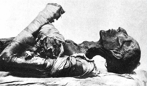 Momie du Pharaon Ramsès II, mort de la variole