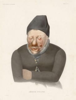Malade de la lèpre, 1835