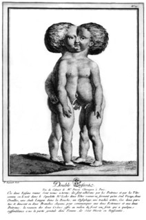 Enfants siamois.