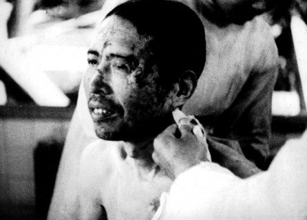 Hiroshima. Victime de la bombe atomique.
