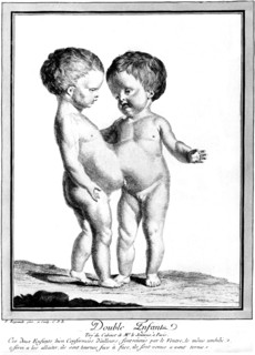 Siamese twins
