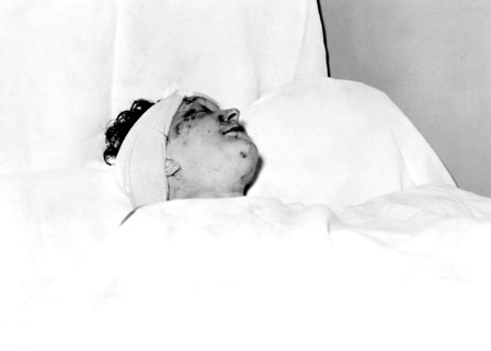 Edith Piaf à l'hopital de Rambouillet après son accident de voiture, 7 septembre 1958