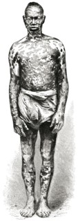 Man with Mottled Skin, Loango Coast, Africa, Illustration, 1885