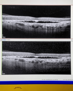 OCT scan (Optical Coherence Tomography) of human retina, both eyes