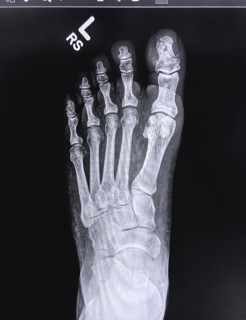 X-ray of broken toe on left foot