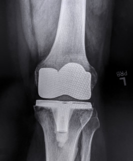 X-ray of adult man's left knee after knee replacement surgery