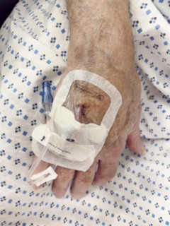 Hospital patient with IV port inserted in his hand