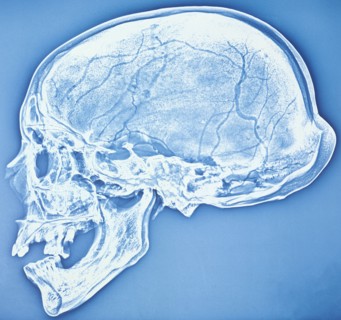 Xeroradiograph of the bathrocranic skull. Artist: Unknown
